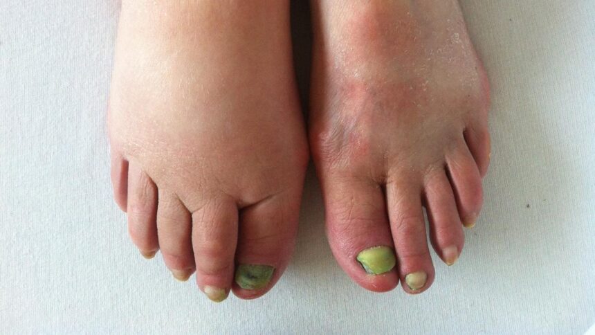 Lymphedema care: from early detection to long-term management