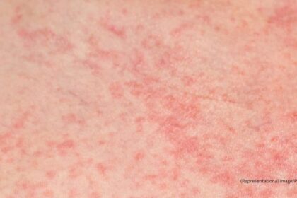 The rising temperatures often trigger several skin problems, heat rash being one of the most common issues