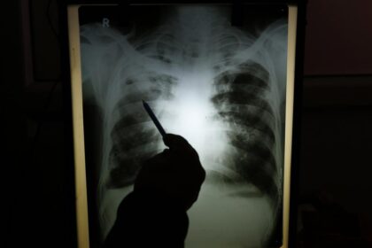 Drug-resistant tuberculosis causes health crisis in India