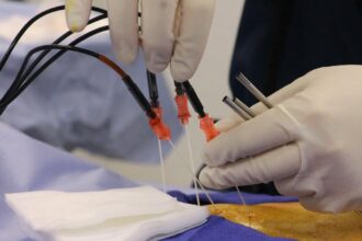 Beyond pills and surgery: How radiofrequency ablation is helping chronic pain patients