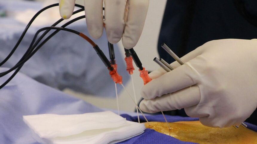Beyond pills and surgery: How radiofrequency ablation is helping chronic pain patients