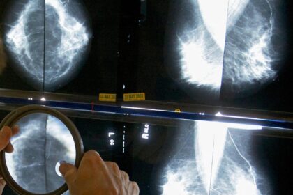 Breast cancer cases in India have more than doubled in 30 years, experts say