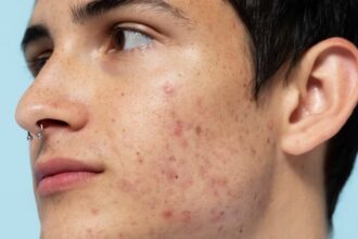 Discover why popping pimples can worsen acne and lead to complications