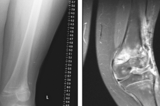 Bang in the knee in children: why it happens and when it is necessary to see a doctor