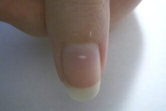 Changes in nails can indicate nutrition, trauma, and chronic disease