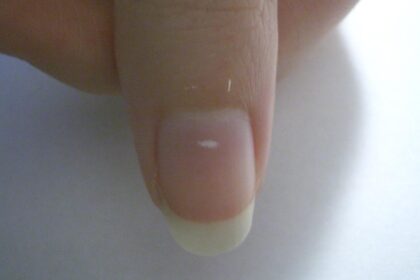 Changes in nails can indicate nutrition, trauma, and chronic disease
