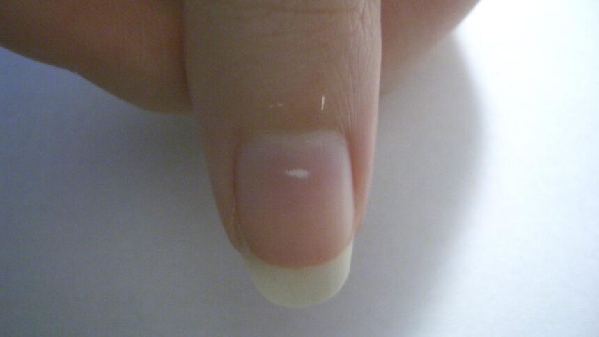 Changes in nails can indicate nutrition, trauma, and chronic disease