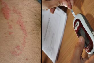 rash