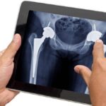 Why are more Indians in their 30s having to undergo hip replacement surgery?
