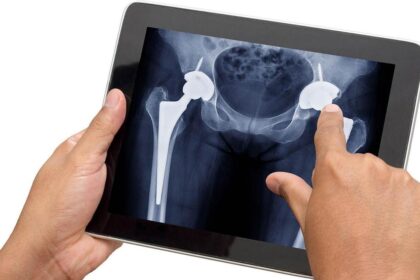 Why are more Indians in their 30s having to undergo hip replacement surgery?