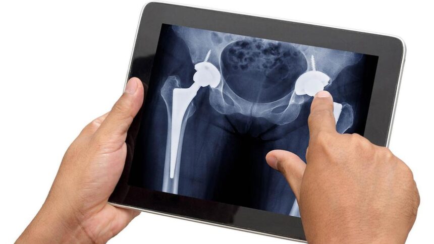 Why are more Indians in their 30s having to undergo hip replacement surgery?