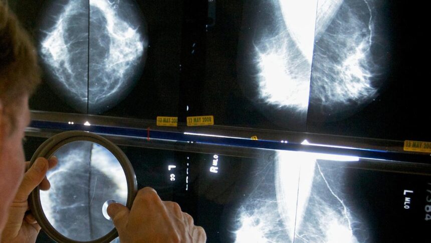 Veracyte genomic test identifies breast cancer patients who can skip chemotherapy