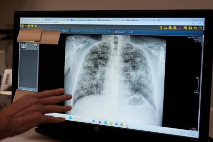 Lung cancer: Scans for early detection and preventive injections