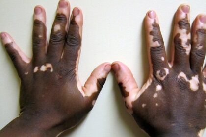 Children with vitiligo face stigma and fight misinformation: this needs to change