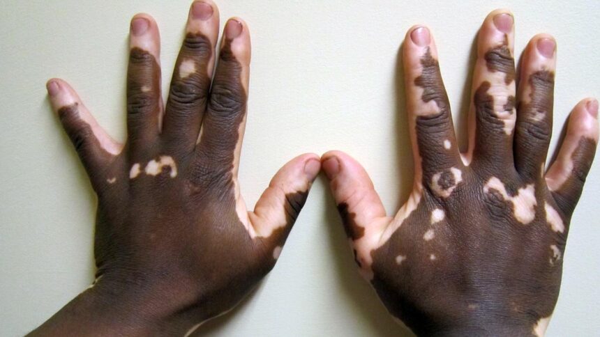 Children with vitiligo face stigma and fight misinformation: this needs to change