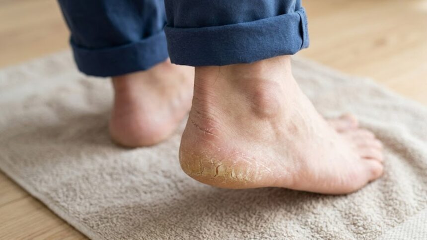 cracked heels