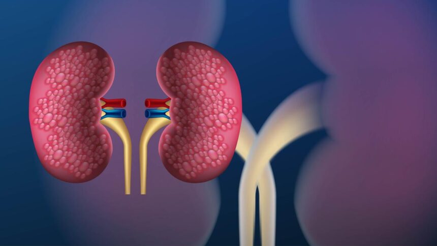 Almost half of the 844 million chronic kidney disease patients worldwide remain undiagnosed: The Lancet